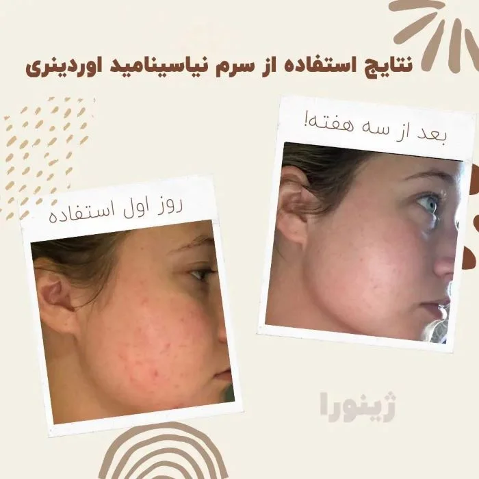 سرم ضد جوش و روشن کننده نیاسینامید 10% + زینک 1% اوردینری